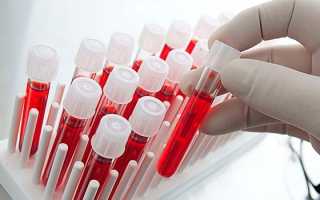 Инфекционный мононуклеоз — пути заражения, симптомы и лечение