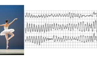 Аритмия типа пируэт: симптомы, диагностика, лечение