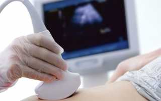 Цистаденома яичника — причины, симптомы и виды заболевания, методы лечения и профилактика