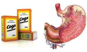 Лечение полипов в кишечнике народными средствами — лучшие рецепты