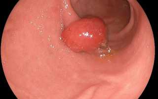 Обнаружение полипа эндометрия на УЗИ