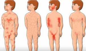 Приорикс вакцина: где сделать, инструкция, цена