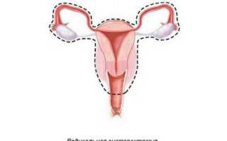 Как проводится радикальная гистерэктомия?