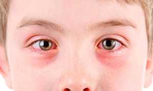 Конъюнктивит — симптомы и лечение глаз