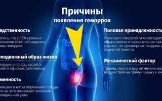 Виды геморроя: причины, симптомы и лечение