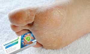 Популярные средства для лечения грибка на ногах
