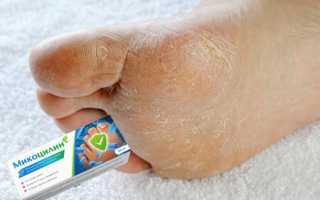 Популярные средства для лечения грибка на ногах