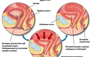 Признаки простуды мочевого пузыря у женщин Здоровая женщина