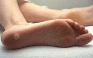 Шпоры на пятках–быстрое и эффективное лечение в домашних условиях. Личный опыт