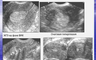 Чем опасна гиперплазия эндометрия и как от нее избавиться?