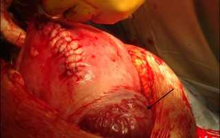 Длительность сокращения матки после кесарева сечения