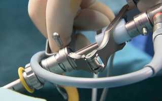 Показания к операции при аденоме простаты и способы хирургического лечения