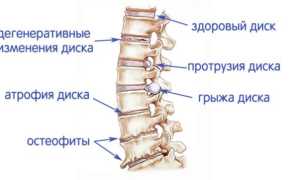 Грыжа диска позвоночника: симптомы, противопоказания и реабилитаци