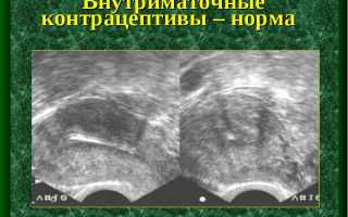 Почему диагностируется гиперэхогенный эндометрий?