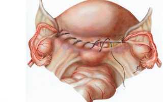 Что такое культя шейки матки после удаления матки?