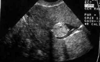 Как проводится диагностика миомы на УЗИ?