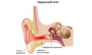 Наружный отит — симптомы и лечение в домашних условиях