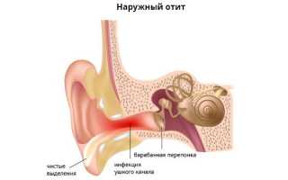 Наружный отит — симптомы и лечение в домашних условиях