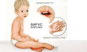 Вирус Коксаки у детей и взрослых —  симптомы и лечение