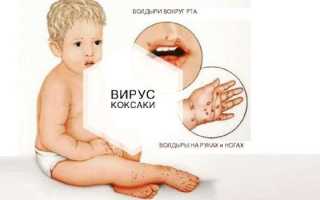 Вирус Коксаки у детей и взрослых —  симптомы и лечение