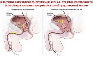 Урология дгпж 1 ст