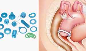 Выпадение матки у женщин пожилого возраста