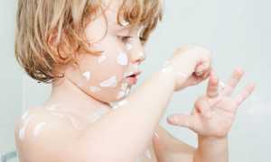 Каламин при ветрянке — инструкция по применению, форма выпуска и противопоказания