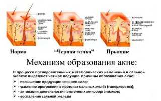 Причины и лечение акне на лице