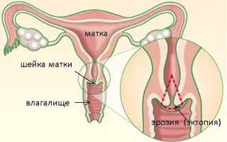 Может ли эрозия шейки матки пройти сама, и в каких случаях это происходит?