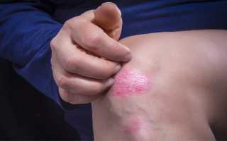 Признаки псориаза у женщин: первые проявления на коже