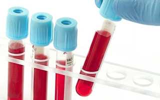 Реактивный артрит у детей: симптомы и лечение болезни