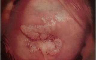 Самые распространенные заболевания матки у женщин