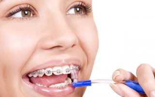 Брекеты и беременность – за и против