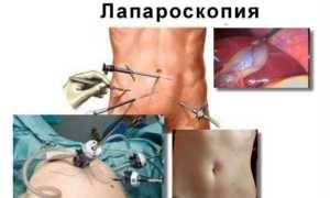 Пупочная грыжа у взрослых — причины возникновения и методы лечения