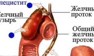 Хронический калькулезный холецистит