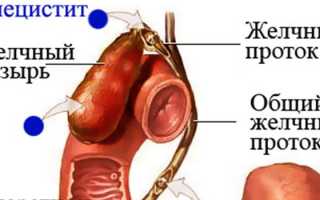 Хронический калькулезный холецистит