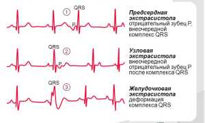 Предсердная экстрасистолия: как определить на ЭКГ и нужно ли лечить