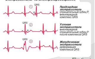 Предсердная экстрасистолия: как определить на ЭКГ и нужно ли лечить