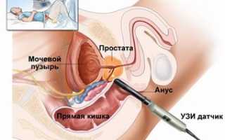 Подготовка к трузи предстательной железы