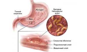 Диагностика язвы желудка — лабораторные и инструментальные методы