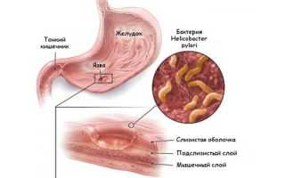 Диагностика язвы желудка — лабораторные и инструментальные методы