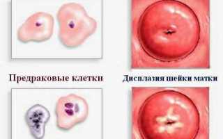 Какие витамины при дисплазии шейки матки необходимо употреблять?