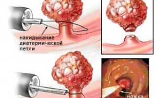 Почему происходит рецидив полипа эндометрия и как его лечить?