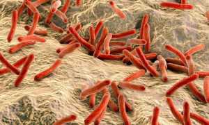 Милиарный туберкулез — особенности и причины развития, проявления, методы лечения, последствия