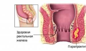 Парапроктит: симптомы и лечение заболевания
