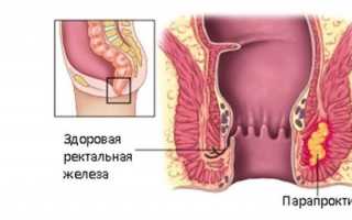Парапроктит: симптомы и лечение заболевания