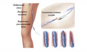 Флебэктомия — показания к проведению операции, профилактика осложнений