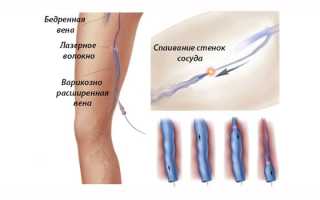 Флебэктомия — показания к проведению операции, профилактика осложнений