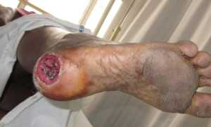 Трофические язвы нижних конечностей – причины и факторы риска, провоцирующие заболевания