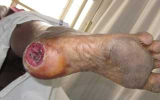 Трофические язвы нижних конечностей – причины и факторы риска, провоцирующие заболевания